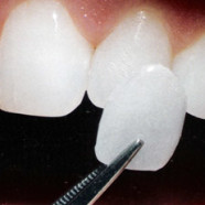 dental veneer